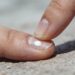 Roer a unha e manicure agressiva causam microtraumas que viram manchas brancas