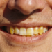 Por que os dentes ficam amarelos mesmo com higiene em dia?
