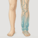 Linfedema: como reconhecer o inchaço nos braços e pernas antes que piore: terapias mais eficazes se iniciadas prontamente