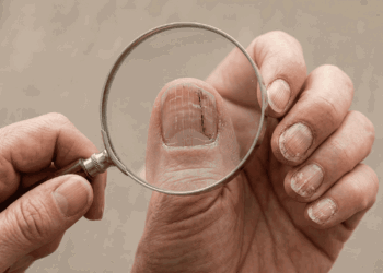 As unhas quebradiças e com linhas verticais estão de alguma forma ligadas a uma função metabólica crucial