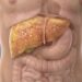 Barriga estufada no fim do expediente? saiba se o problema é apenas má digestão ou fígado sobrecarregado (esteatose)