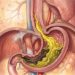Refluxo gastroesofágico: por que ocorre e o que pode ser feito para aliviá-lo