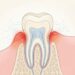 Como tratar a dor de dente à noite e diminuir o risco de infecção