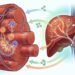 Como usar creatina para tratar a inflamação no fígado e garantir a energia celular a longo prazo
