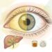 Uma das maneiras de identificar problemas no fígado é através da coloração amarelada nos olhos e na pele