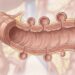 A maioria das pessoas desenvolve diverticulose intestinal por volta dos 80 anos. Então, o que é isso?