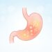Como saber se o mau hálito é sintoma de inflamação no intestino ou estômago