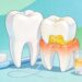 Remédio natural para tártaro: receita caseira fácil para limpar os dentes em casa