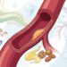 Colesterol alto: O que comer para reduzir o LDL e melhorar o perfil lipídico?