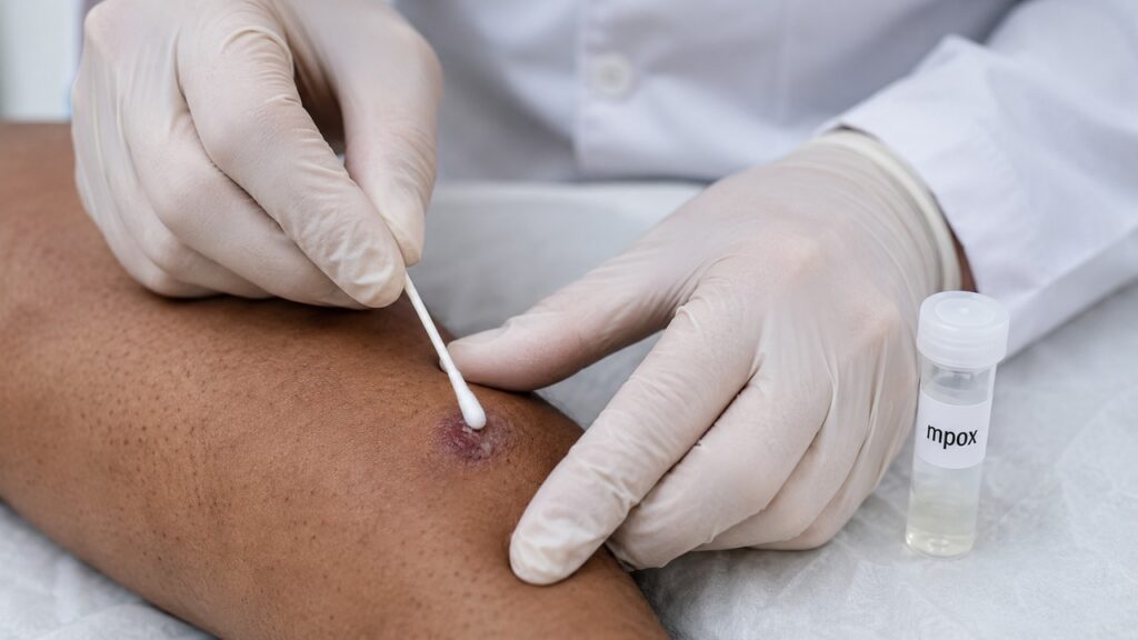 A coleta da lesão pode confirmar a suspeita de mpox por teste laboratorial.