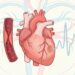 O que é infarto silencioso? Veja os sintomas e o tratamento