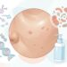 Por que algumas pessoas têm acne na vida adulta mesmo cuidando da pele?