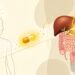 A falta de vitamina D no organismo geralmente não se deve à falta de exposição ao sol, mas sim a problemas digestivos crônicos, como inflamação intestinal ou irritação persistente do fígado