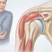 Bursite não é só dor articular: como reconhecer a inflamação das pequenas bolsas perto das juntas