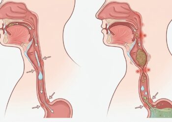 Dificuldade de engolir que piora aos poucos exige atenção mesmo sem dor de garganta