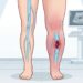Trombose: o que é e como diferenciá-la de uma simples dor muscular na perna para não retardar o tratamento