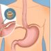 5 dicas para tomar café com leite e evitar azia pela manhã