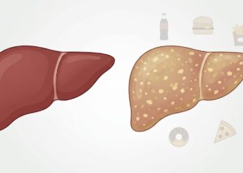 Carne processada e fígado gorduroso: por que linguiça, presunto e embutidos preocupam além do colesterol