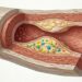 Microplásticos nas placas das artérias: o estudo que acendeu um novo alerta cardiovascular