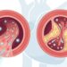 Quais são os níveis ideais de colesterol no sangue?