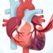 Infarto ou angina: quais são as diferenças e quando se preocupar?