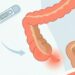 Apendicite: o que é e como diferenciá-la de uma simples dor de barriga para evitar atrasos no tratamento