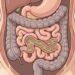 Inchaço, plenitude e desconforto após refeições: quando investigar supercrescimento bacteriano no intestino