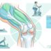 Como melhorar a mobilidade do joelho naturalmente para conviver melhor com a artrose