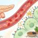 O que é resistência à insulina e como detectá-la a tempo de prevenir o diabetes?