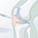 O sangue menstrual repara a cartilagem no tecido osteoartrítico