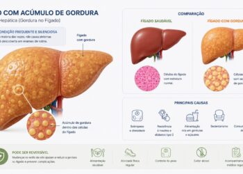 A gordura no fígado pode evoluir por anos sem causar sintomas evidentes.