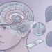 Uma análise revela que pacientes com demência apresentam quantidades ampliadas de nanoplásticos no tecido cerebral