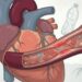 Uma pesquisa afirma que pacientes com infarto apresentam níveis mais elevados de micro e nanoplásticos na corrente sanguínea