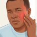 Vermelhidão recorrente no rosto após calor ou comida apimentada pode ser sinal de rosácea.