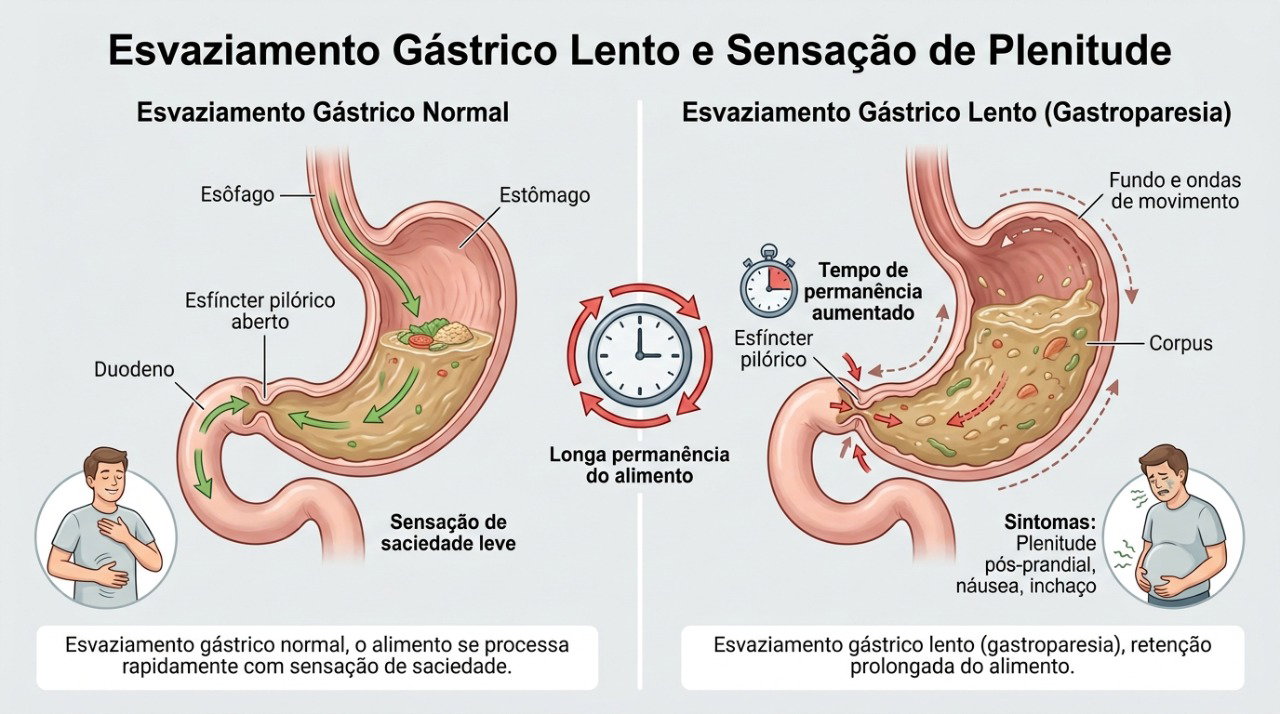Esvaziamento gástrico lento pode causar saciedade precoce, inchaço e náusea após pequenas refeições.
