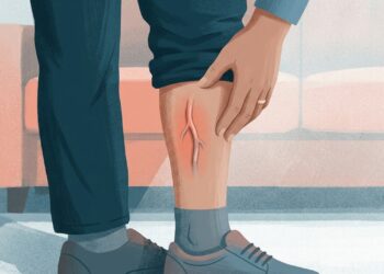 Veia endurecida, vermelha e dolorida na perna pode indicar uma inflamação que precisa de avaliação