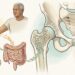 A osteoporose em adultos e idosos não decorre apenas da falta de cálcio, mas também da deficiência de vitamina D, que permite a absorção do cálcio pelos ossos