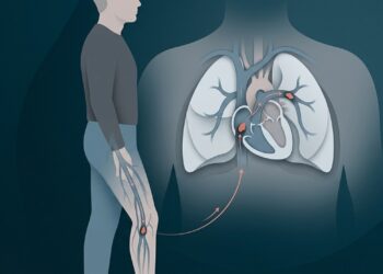Embolia pulmonar: os três sinais no peito e na respiração que pedem hospital no mesmo dia