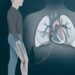 Embolia pulmonar: os três sinais no peito e na respiração que pedem hospital no mesmo dia