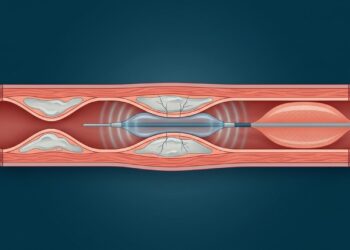 Depois do stent, a maior preocupação é a reobstrução: nova abordagem brasileira tenta reduzir esse risco