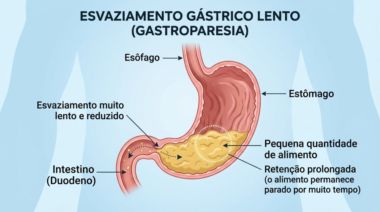 Alterações no esvaziamento do estômago podem contribuir para sensação de plenitude logo no início da refeição.
