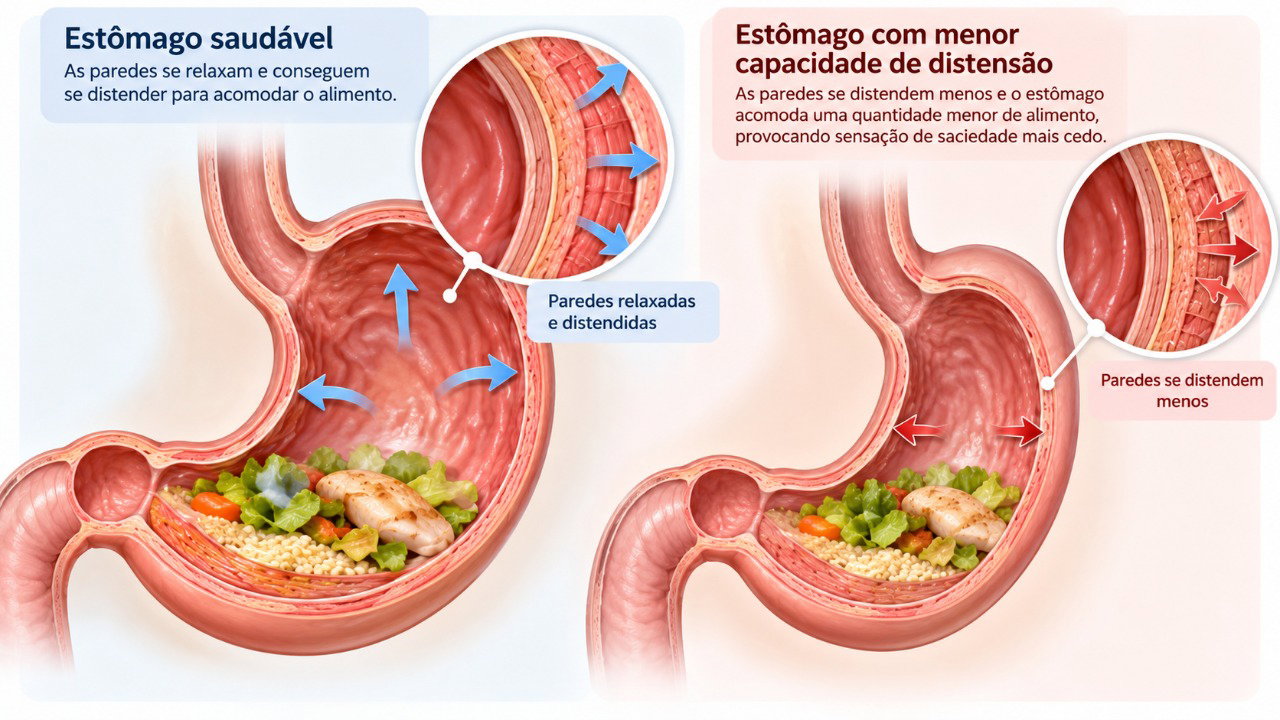 Alterações na capacidade do estômago de acomodar os alimentos podem provocar sensação de saciedade mesmo após pequenas refeições.