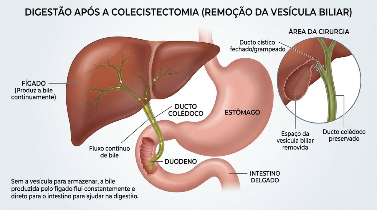 Após a retirada da vesícula, a bile produzida pelo fígado passa a chegar continuamente ao intestino, podendo favorecer episódios de diarreia.
