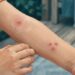 Impetigo: sinais iniciais na pele que costumam ser confundidos com picada ou alergia