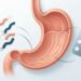 H. pylori, uso frequente de anti-inflamatórios e tabagismo contribuem para a úlcera no estômago