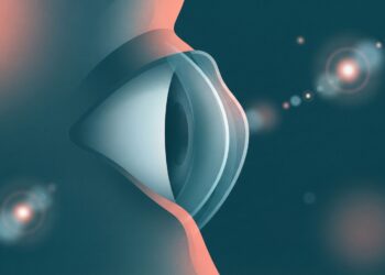 Ceratocone: os sinais que fazem o oftalmologista desconfiar da doença