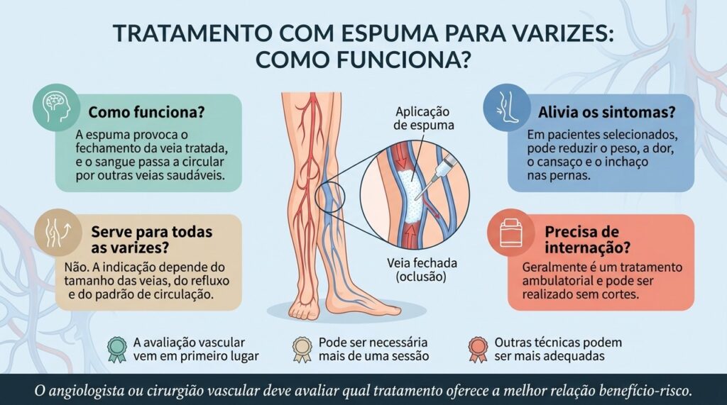 A escleroterapia com espuma é menos invasiva do que a cirurgia aberta, mas sua indicação depende do tipo de variz e da circulação de cada pessoa.