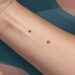 Angioma rubi ou pinta comum: como diferenciar pela aparência